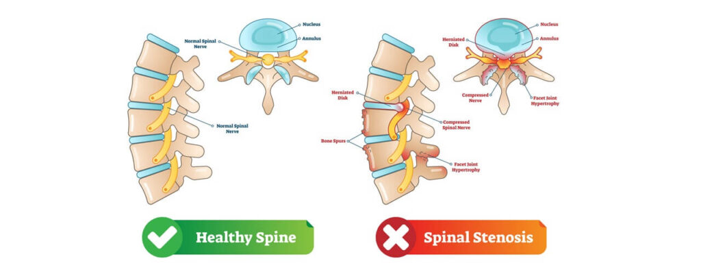 Empowering Recovery: The Role of Physical Therapy in Treating Spinal Stenosis